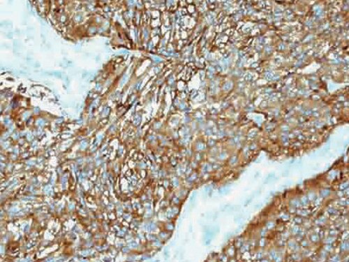 IHC of Synaptophysin on an FFPE Neuroendocrine Tumor